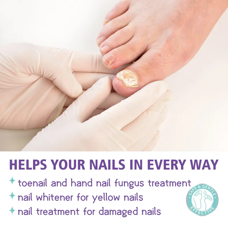 NAIL FANGUS SPRAY